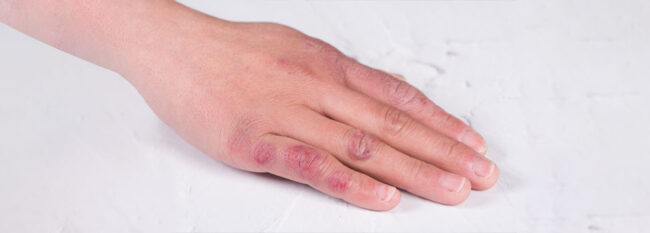 Chilblains on a woman's hand.