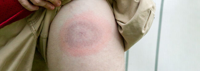 Lyme disease bulls eye rash on mans leg caused by a tick bite.